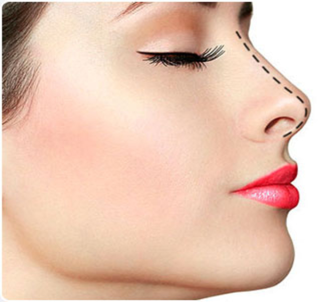 Doctor Branko Glušac showing nose with lines before the surgery